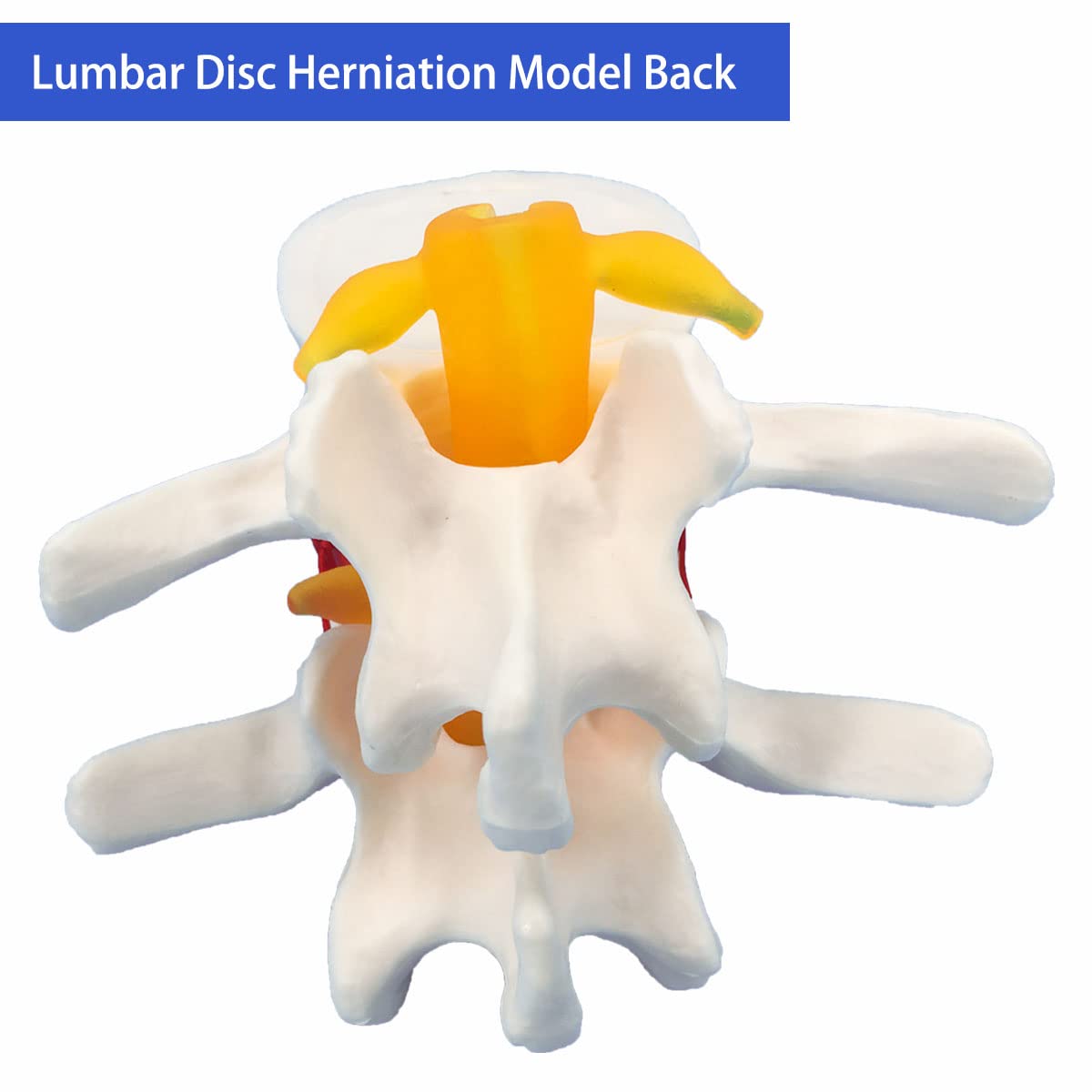 Veipho Human Anatomical Lumbar Disc Herniation Model, Movable Human Lumbar Disc Herniation Model, 1.5 Times Life Size Lumbar Dis