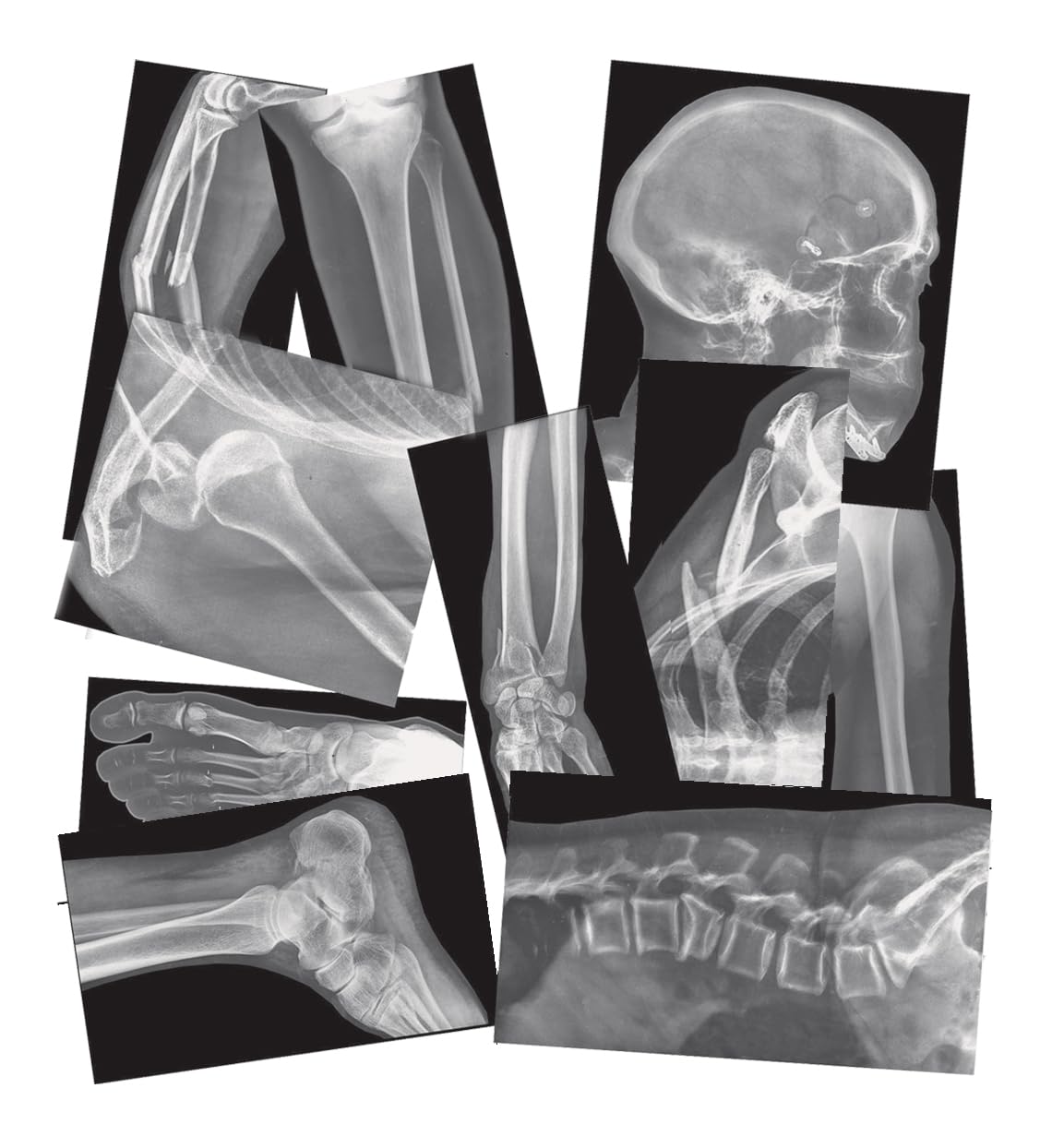 Roylco Broken Bones X-Rays – 15 Realistic Fracture Images For Stem/Steam Learning, Classroom Anatomy, Health Education, And Labs – Perfect For Teachers, Parents, And Medical Training