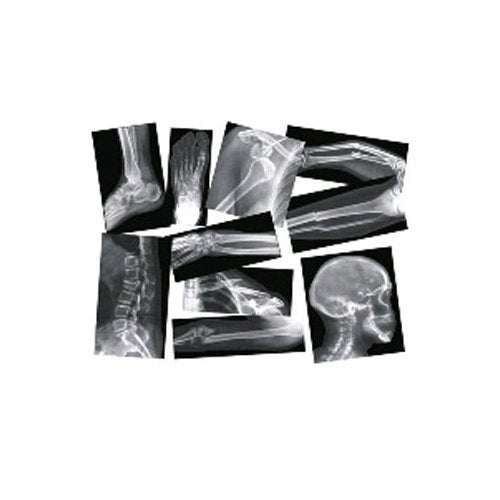 Broken Bones X-rays Set (Box of 15)
