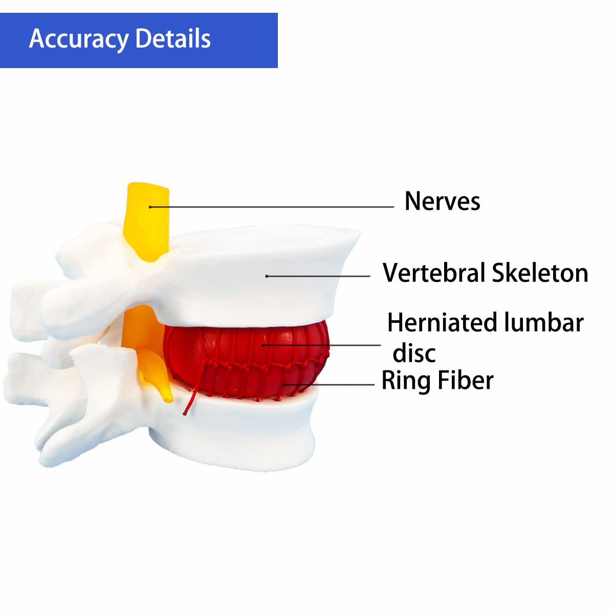 Veipho Human Anatomical Lumbar Disc Herniation Model, Movable Human Lumbar Disc Herniation Model, 1.5 Times Life Size Lumbar Dis