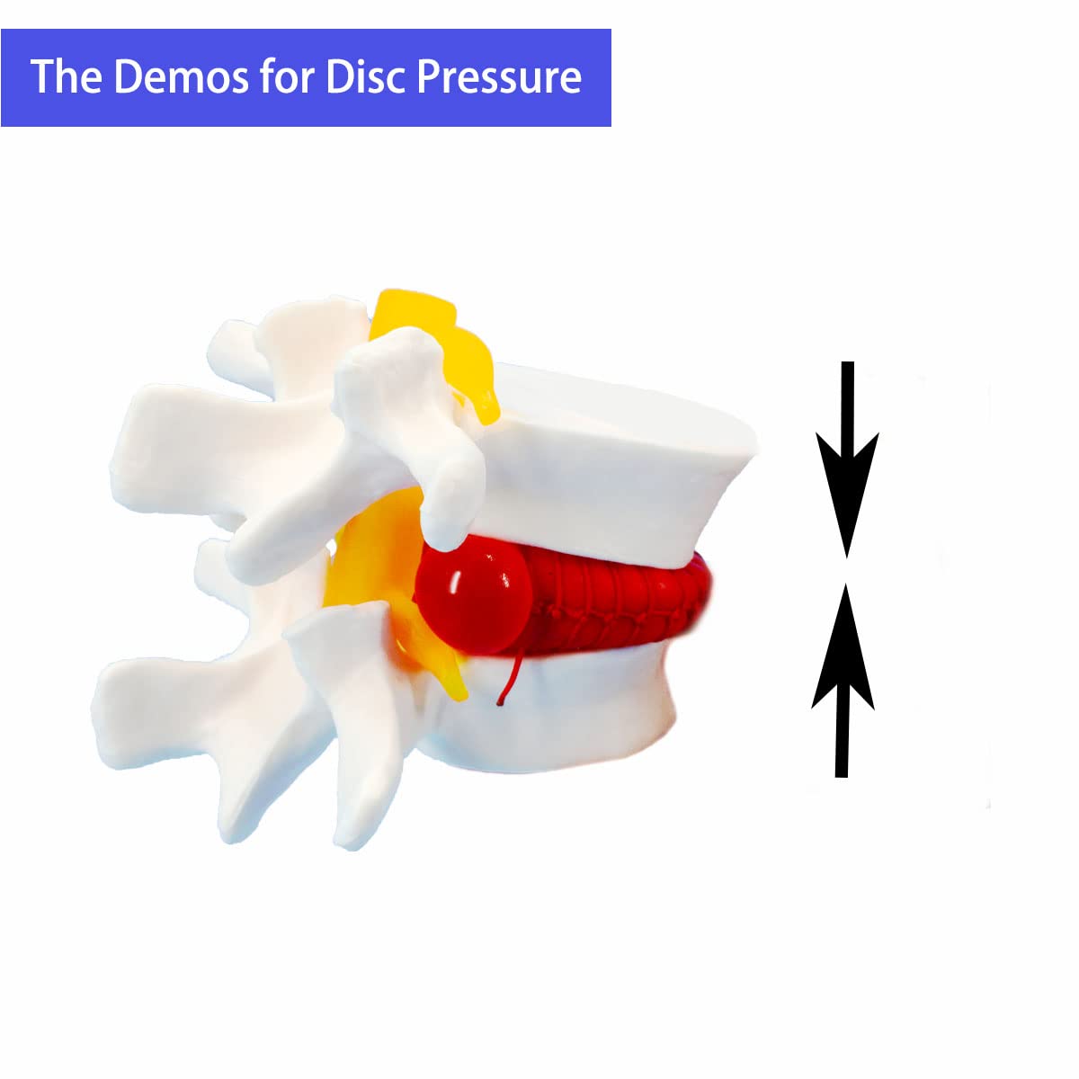 Veipho Human Anatomical Lumbar Disc Herniation Model, Movable Human Lumbar Disc Herniation Model, 1.5 Times Life Size Lumbar Dis