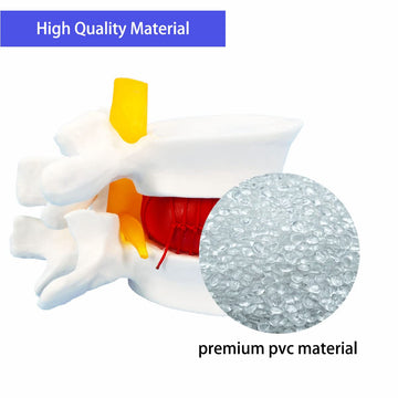 Veipho Human Anatomical Lumbar Disc Herniation Model, Movable Human Lumbar Disc Herniation Model, 1.5 Times Life Size Lumbar Dis
