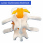 Veipho Human Anatomical Lumbar Disc Herniation Model, Movable Human Lumbar Disc Herniation Model, 1.5 Times Life Size Lumbar Dis
