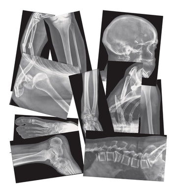 Roylco Broken Bones X-Rays – 15 Realistic Fracture Images For Stem/Steam Learning, Classroom Anatomy, Health Education, And Labs – Perfect For Teachers, Parents, And Medical Training