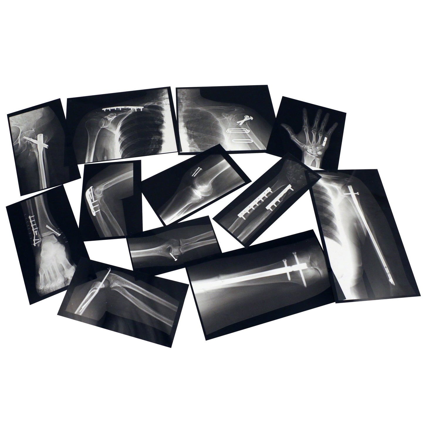 FIXED BONES XRAYS