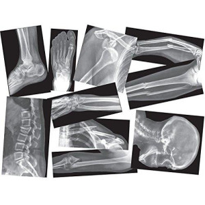 Roylco Broken Bones X-Ray Set, Projector Display Compatible, 15 X-Rays