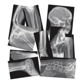 Roylco Broken Bones X-Ray Set, Projector Display Compatible, 15 X-Rays