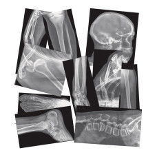 Roylco Broken Bones Xrays 15 Realistic Fracture Images For Stemsteam Learning Classroom Anatomy Health Education And Labs